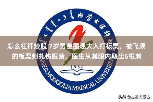 怎么杠杆炒股 7岁男童围观大人打板栗，被飞溅的板栗刺扎伤眼睛，医生从其眼内取出6根刺
